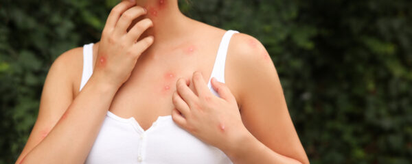 allergie aux moustiques